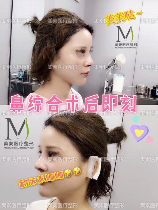 郑州做下巴哪家专业→郑州做抽脂哪家好 