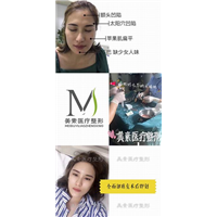自体脂肪填充术后效果 