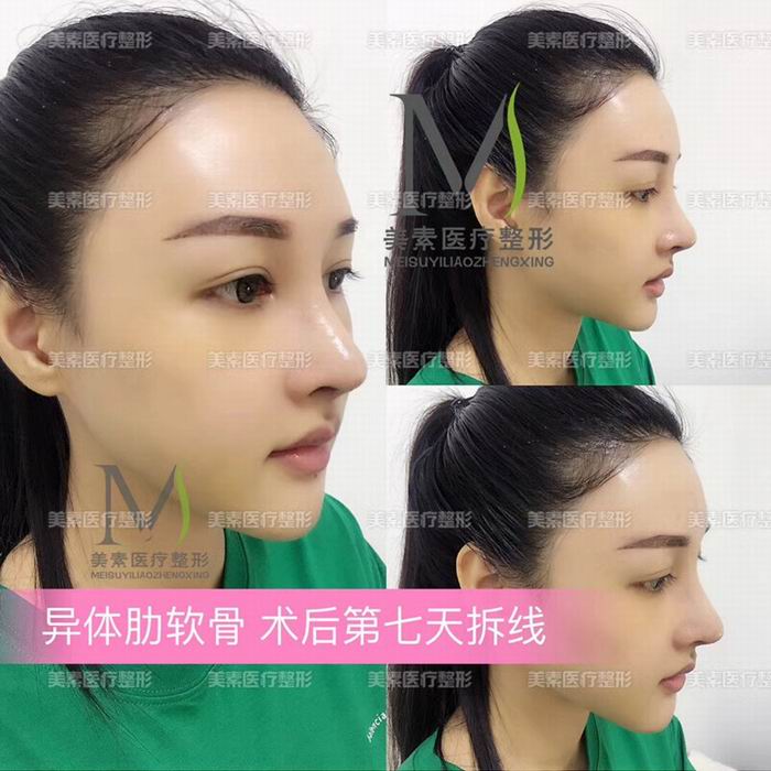 郑州网红整形→郑州美素整形 