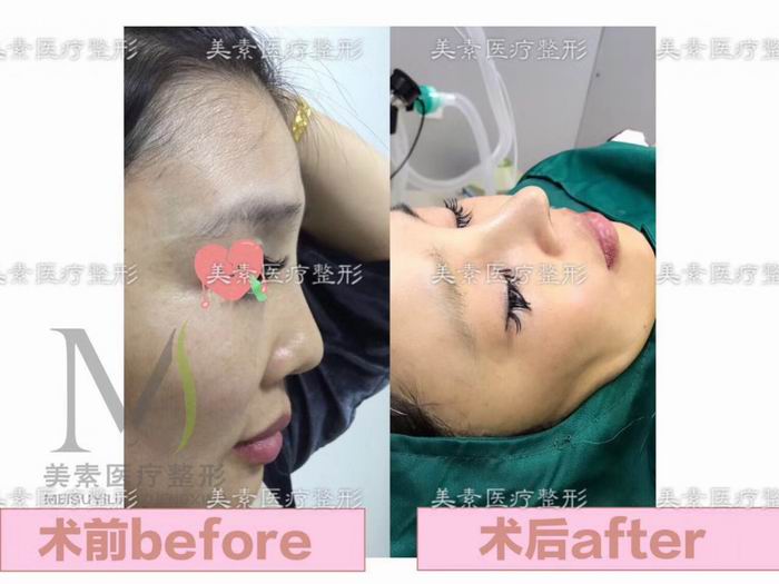 郑州自体脂肪隆胸→郑州做下巴哪家专业 