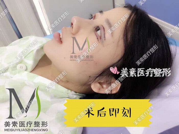 郑州眼综合整形术后效果 