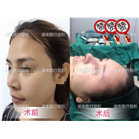 郑州网红整形→郑州美素整形 