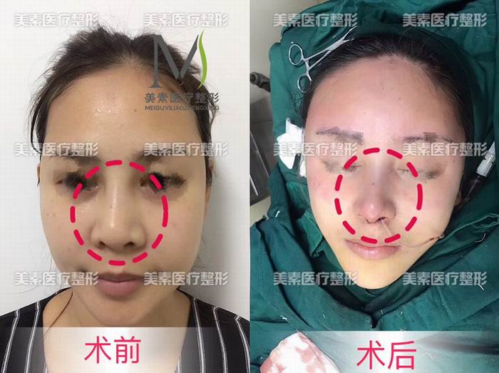 郑州做下巴哪家专业→郑州做抽脂哪家好 