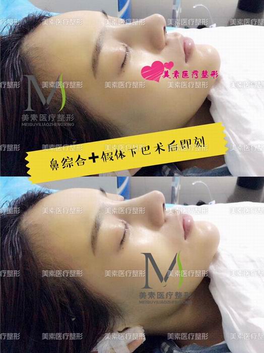郑州网红整形→郑州美素整形 