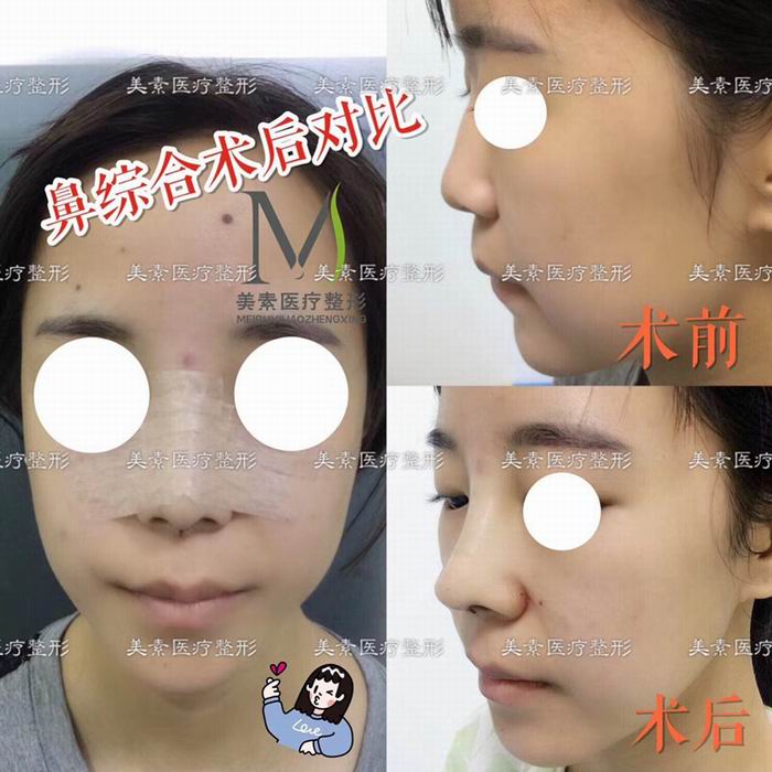 郑州自体脂肪隆胸→郑州做下巴哪家专业 