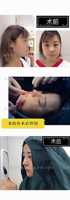 郑州自体脂肪隆胸→郑州做下巴哪家专业 