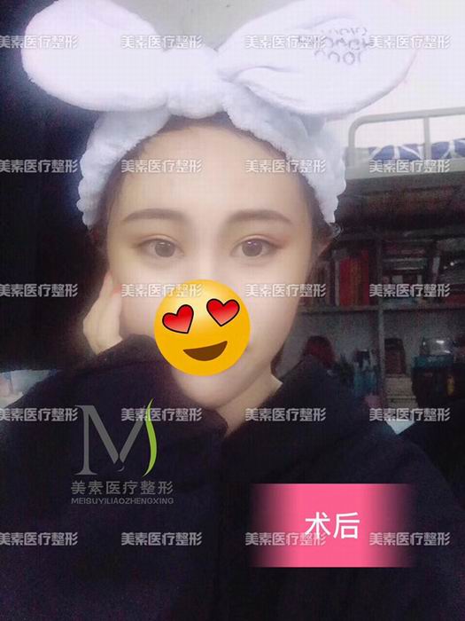 郑州眼综合整形、郑州眼综合整形哪家好 