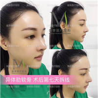 郑州网红整形→郑州美素整形 
