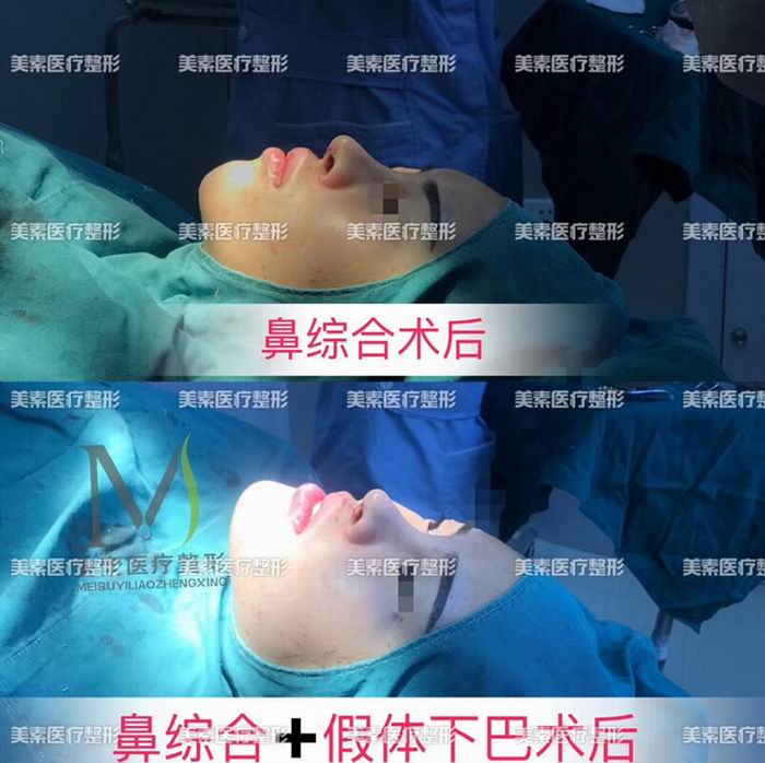 郑州网红整形→郑州美素整形 