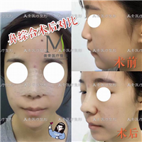 郑州自体脂肪隆胸→郑州做下巴哪家专业 