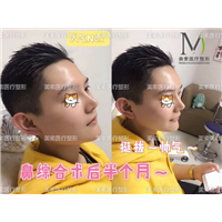郑州做下巴哪家专业→郑州做抽脂哪家好 
