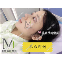 郑州眼综合整形术后效果 