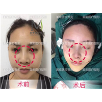 郑州做下巴哪家专业→郑州做抽脂哪家好 