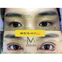 郑州做开眼角哪家医院专业 