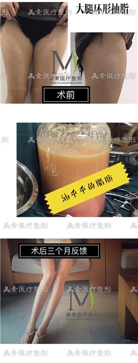 郑州自体脂肪填充额头 