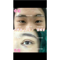 眼综合术后效果 