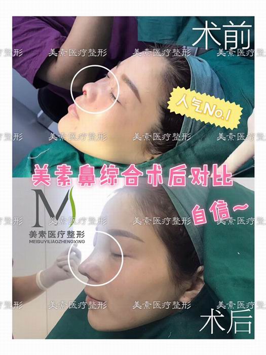 郑州自体脂肪隆胸→郑州做下巴哪家专业 