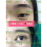 郑州美素医疗整形-术后效果 