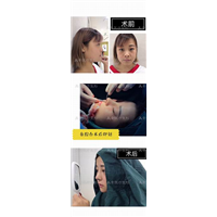 郑州自体脂肪隆胸→郑州做下巴哪家专业 