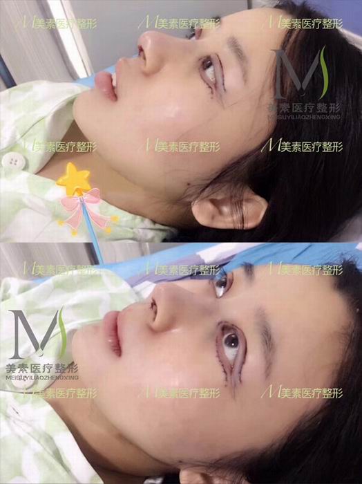 郑州芭比眼整形、郑州网红芭比眼综合 