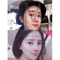 郑州网红眼综合整形 