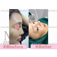 郑州自体脂肪隆胸→郑州做下巴哪家专业 