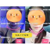 下巴 