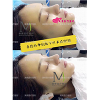 郑州网红整形→郑州美素整形 