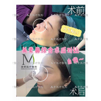 郑州自体脂肪隆胸→郑州做下巴哪家专业 