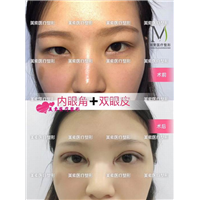 郑州做双眼皮哪家医院比较好 