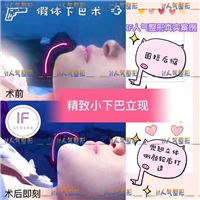 IF人气网红整形-精致小下巴立现