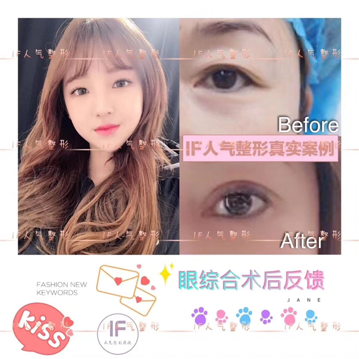 厦门人气网红整形|厦门眼综合整形