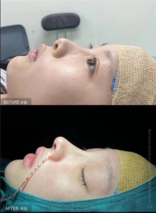 厦门鼻综合整形专家