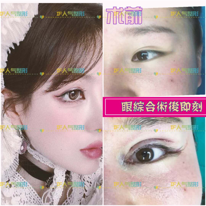 厦门鼻综合整形\厦门网红整形
