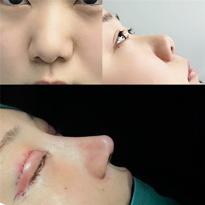 厦门鼻综合整形专家