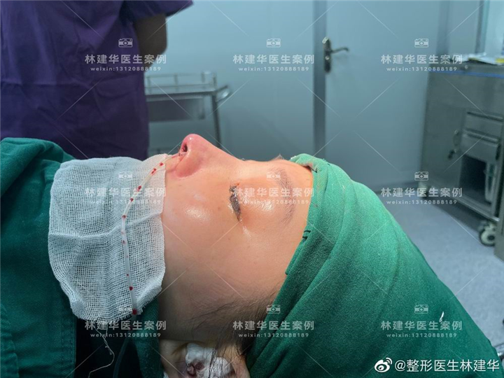 厦门鼻综合整形专家