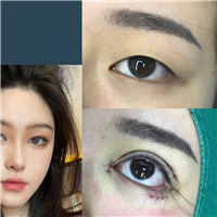 厦门眼综合整形专家