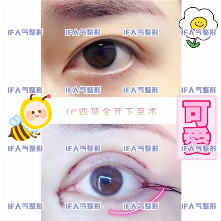 厦门鼻综合整形\厦门网红整形