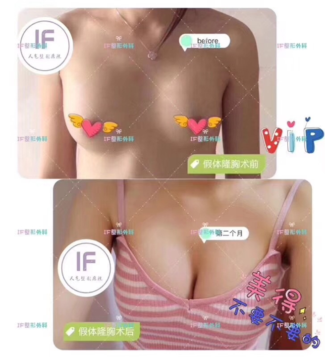 厦门IF打造 假体隆胸术前术后效果对比