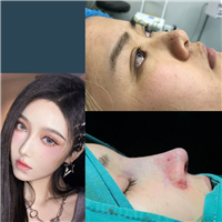 厦门鼻综合整形专家