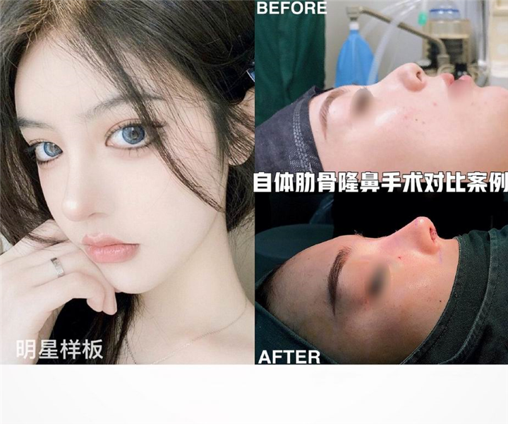 厦门鼻综合整形专家