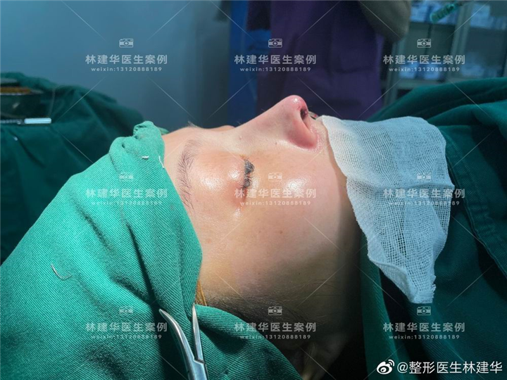 厦门鼻综合整形专家