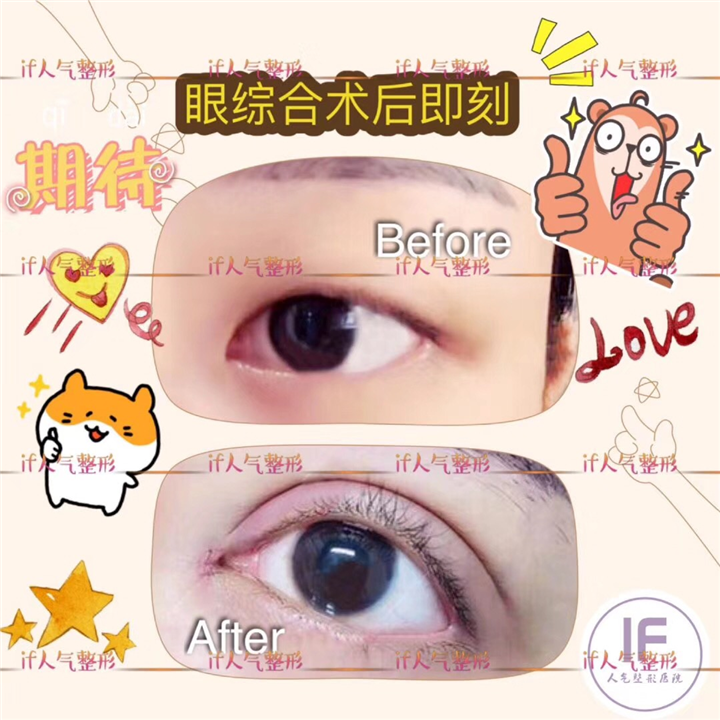 厦门人气网红整形|厦门眼综合整形