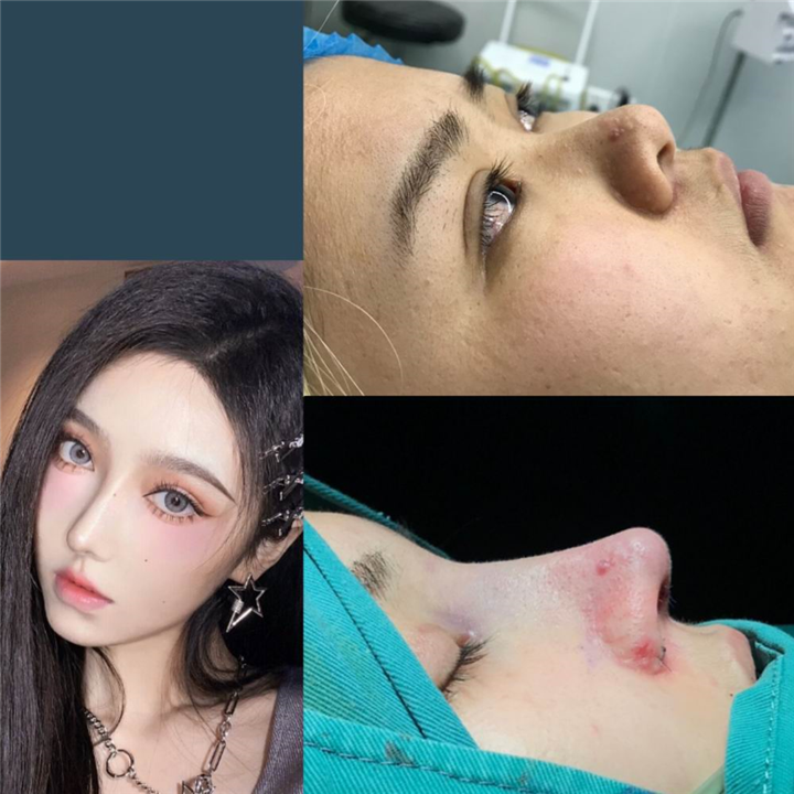 厦门鼻综合整形专家