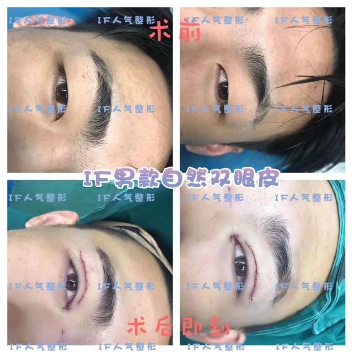 厦门鼻综合整形\厦门网红整形
