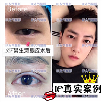 厦门眼综合整形|厦门做眼综合哪家好