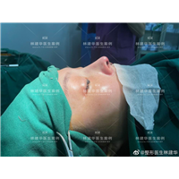 厦门鼻综合整形专家