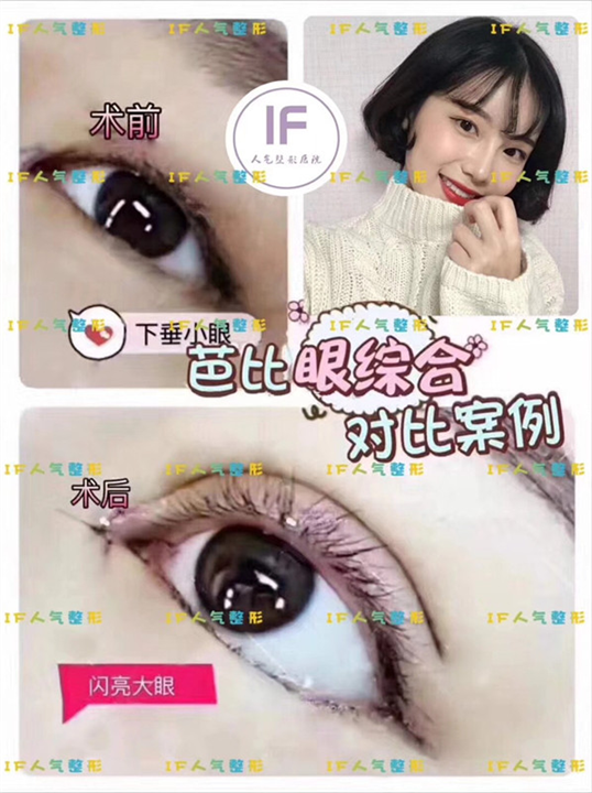 厦门人气网红整形|厦门眼综合整形