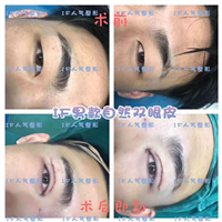 厦门鼻综合整形\厦门网红整形