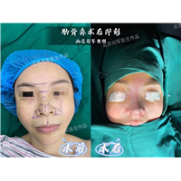 北京鼻整形医生；刘军医生